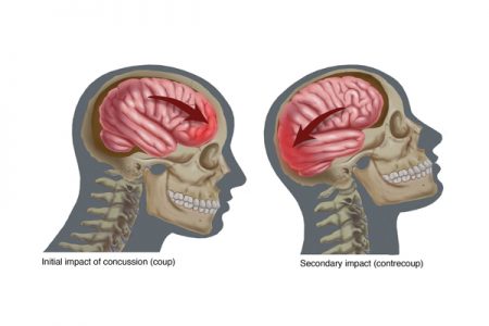 SLGL.Concussion SLGL.Concussion